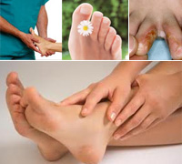 Грибок на ногах - лечение грибка на ногах, грибка стопвы, грибка между пальцами за 3 дня с использованием Органического серебра